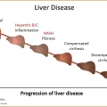 Progression of Liver Disease